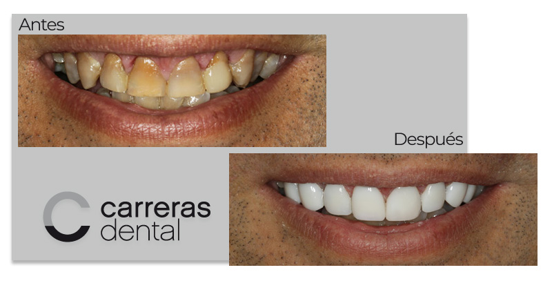 Caso Clínico - Estética Dental - Carreras Dental - Terrassa