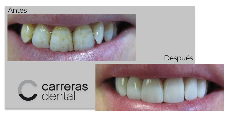 Caso Clínico - Estética Dental - Carreras Dental - Terrassa