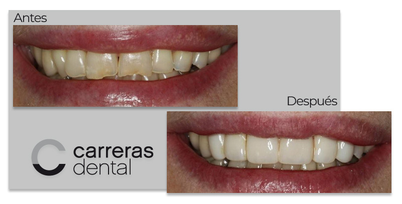 Caso Clínico - Estética Dental - Carreras Dental - Terrassa
