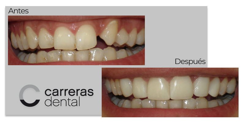 Caso Clínico - Estética Dental - Carreras Dental - Terrassa