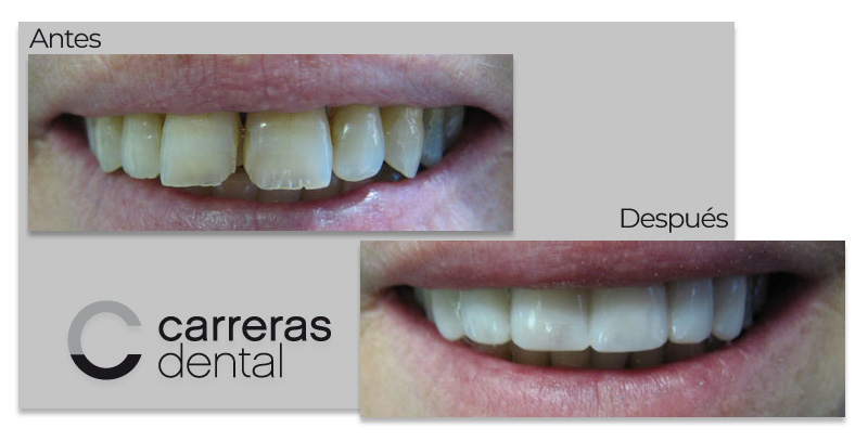Caso Clínico - Estética Dental - Carreras Dental - Terrassa