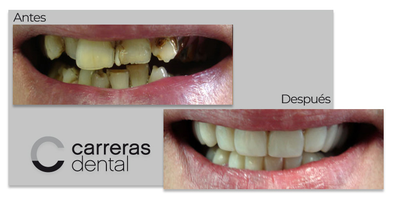Caso Clínico - Estética Dental - Carreras Dental - Terrassa