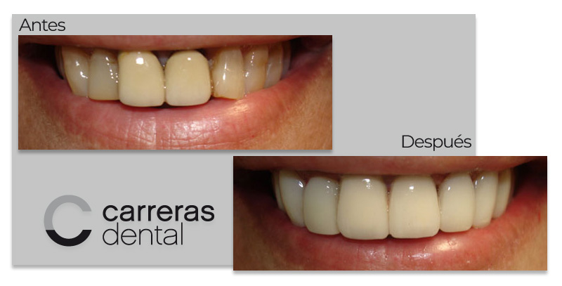 Caso Clínico - Estética Dental - Carreras Dental - Terrassa
