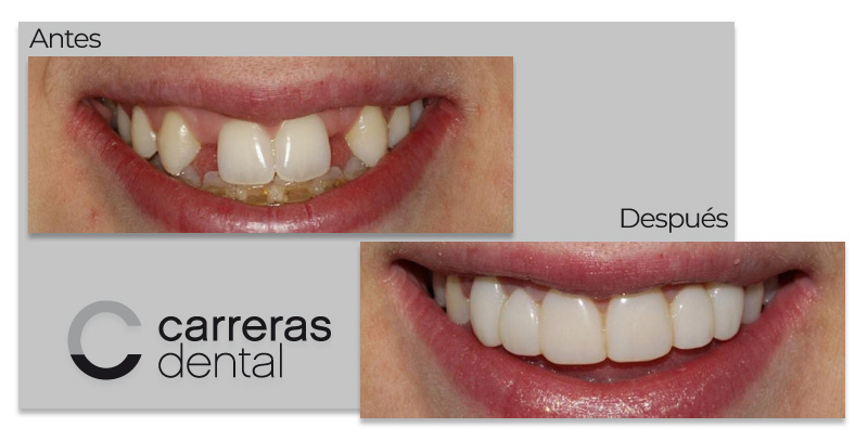 Caso Clínico - Estética Dental - Carreras Dental - Terrassa