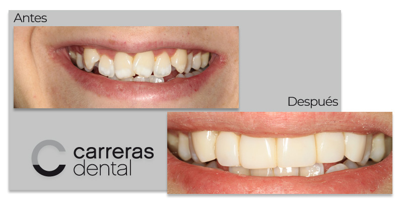 Caso Clínico - Estética Dental - Carreras Dental - Terrassa