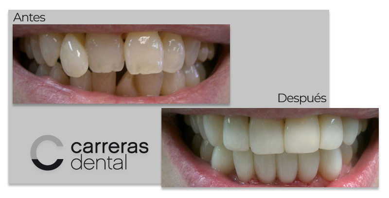 Caso Clínico - Estética Dental - Carreras Dental - Terrassa